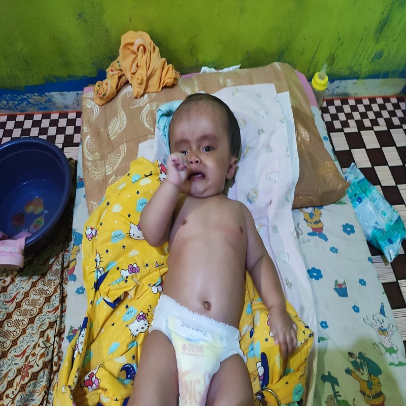 BAYI WIDIA ANAK TUKANG BASO GORENG, IDAP HYDROCEPHALUS