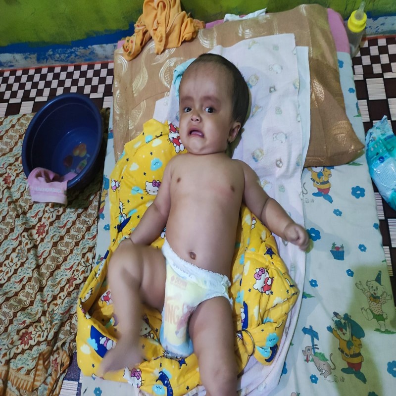 BAYI WIDIA ANAK TUKANG BASO GORENG, IDAP HYDROCEPHALUS