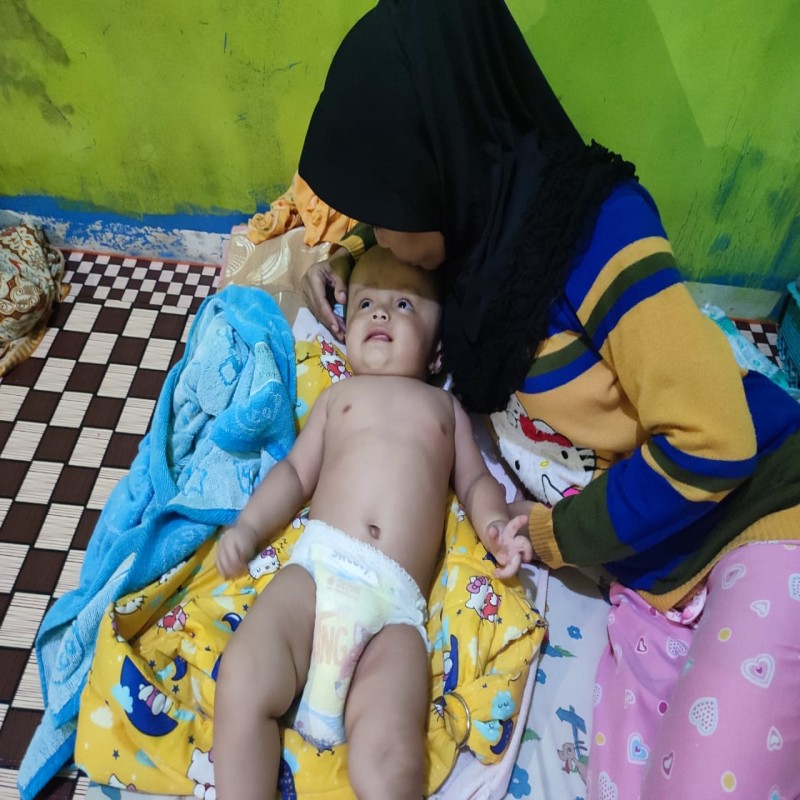 BAYI WIDIA ANAK TUKANG BASO GORENG, IDAP HYDROCEPHALUS