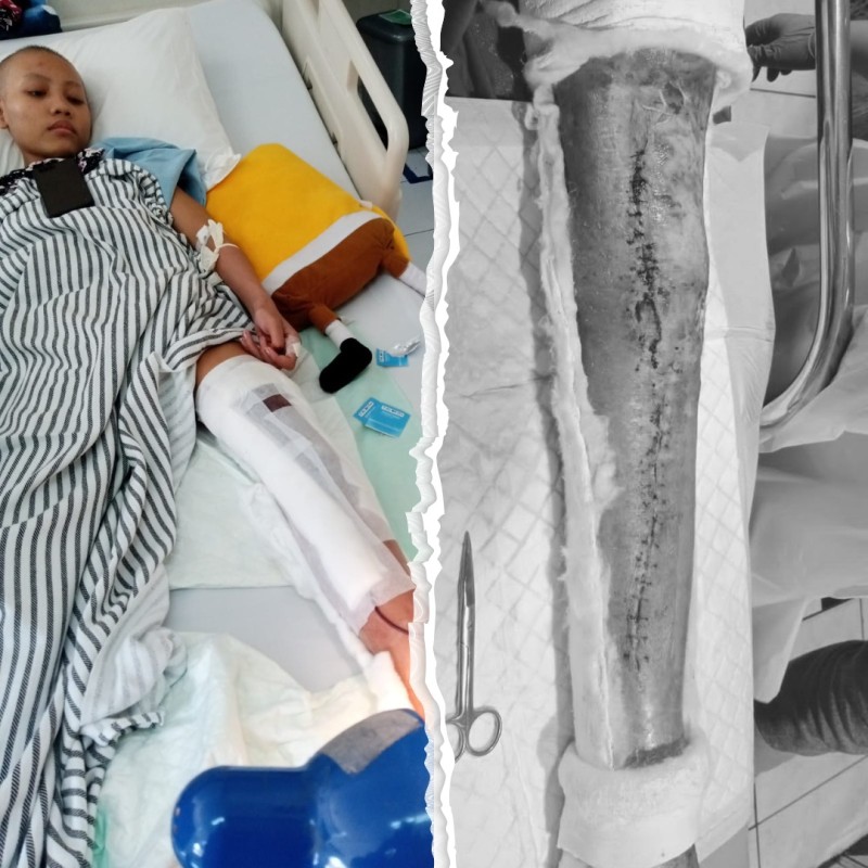 Temani Perjuangan Fhirli Melawan Kanker Tulang