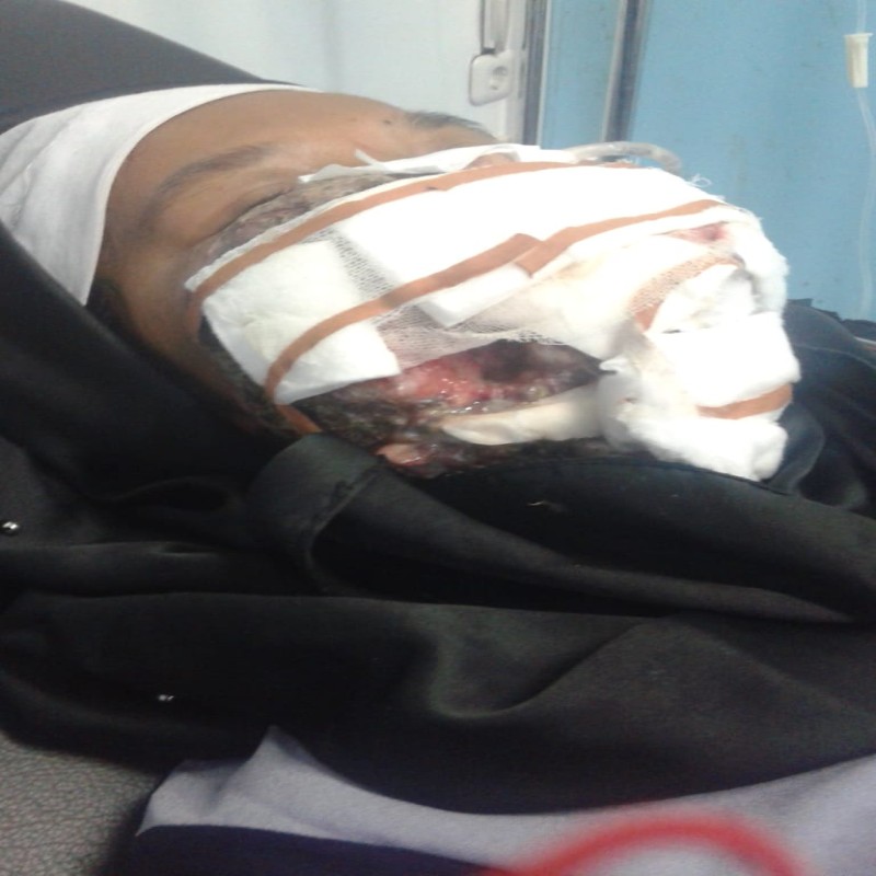 Urgent! Mulut dan Hidung Sudah Dipenuhi Tumor Ganas, Bantu Ibu Isoh Segera Berobat.