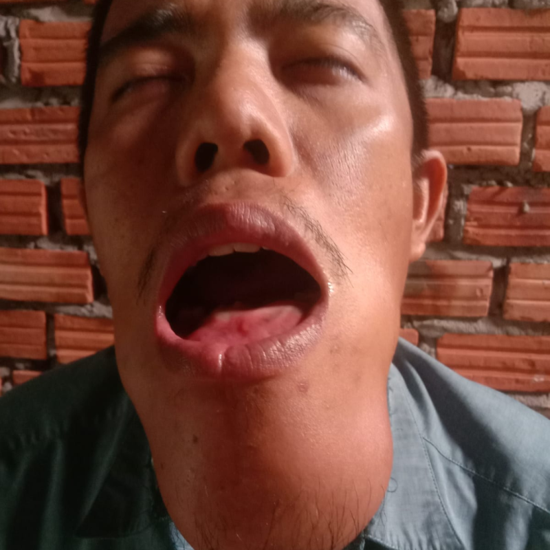 Pak Zainul Tidak Ada Biaya Untuk Obati Tumornya