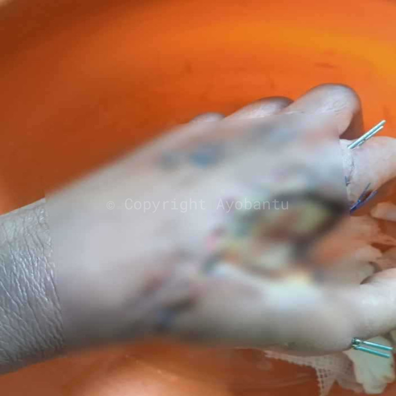 Tangan Hancur Akibat Ledakan, Operasi Tertunda Karena Tunggakan RS