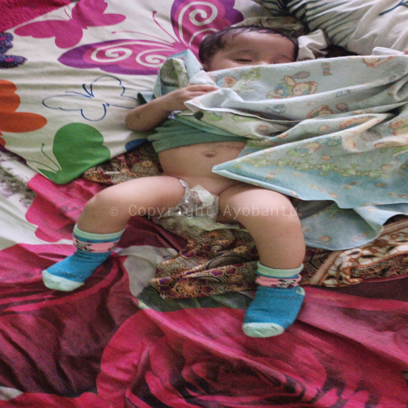 Bantu Bayi Ashfa Lahir Tanpa Anus, harus segera jalani 3 kali Operasi