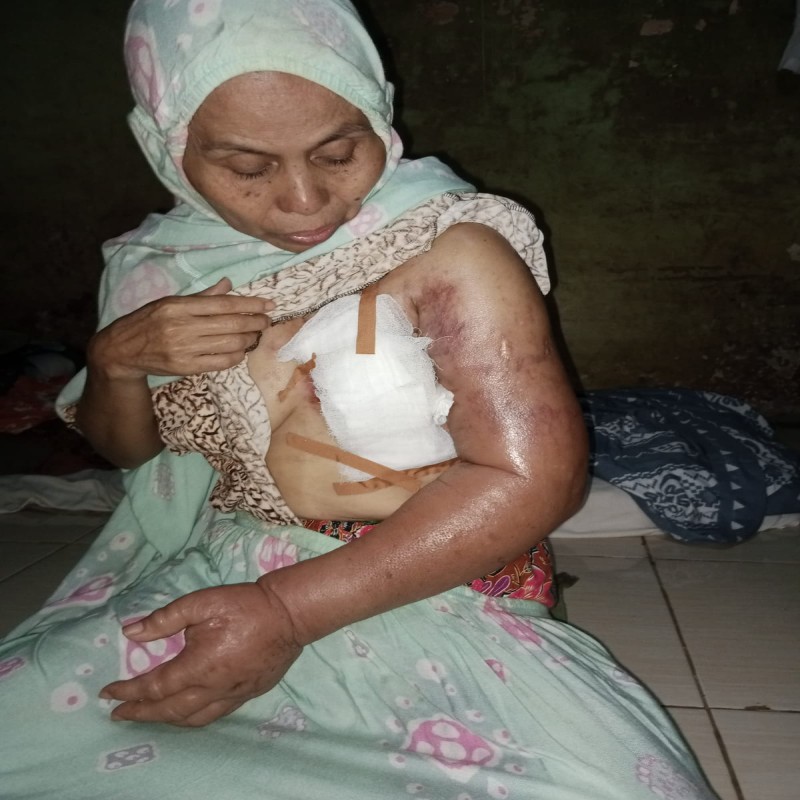 BANTU KARNASIH SEMBUH DARI KANKER PAYUDARA