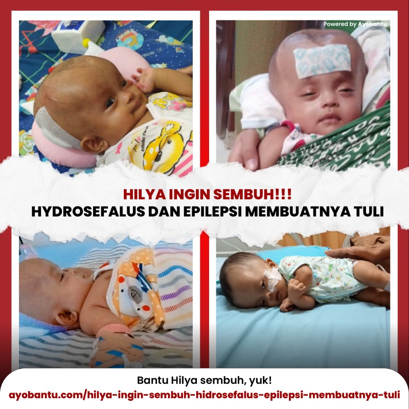 Hilya Ingin Sembuh: Hidrosefalus & Epilepsi Membuatnya Tuli