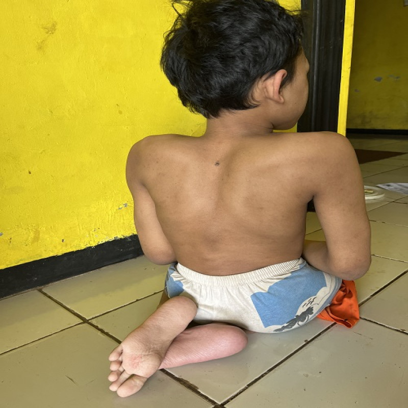 Alami Kecelakaan Tragis, Kahfi Berjuang Dari Kelumpuhan Total