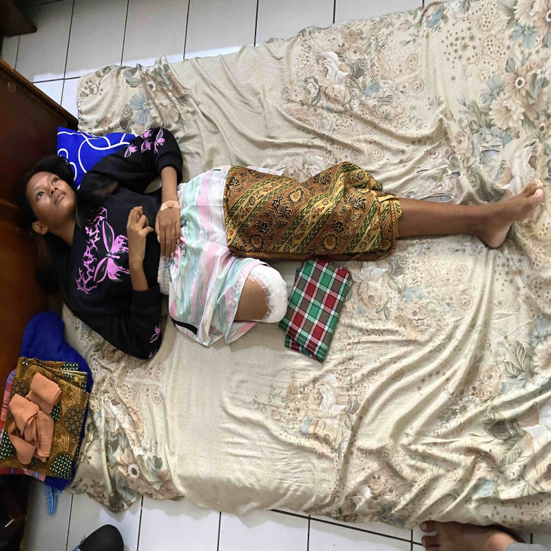 Kaki Diamputasi! Bantu Dini Lawan Kanker Ganas
