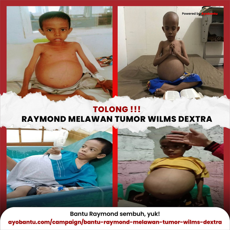 Bantu Raymond melawan tumor wilms dextra