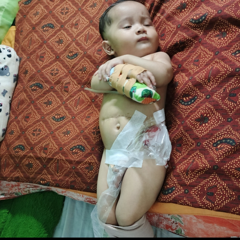 Bantu Bayi Ashfa Lahir Tanpa Anus, harus segera jalani 3 kali Operasi