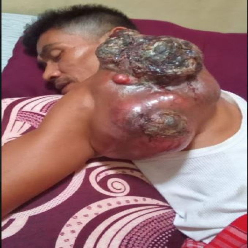 Tumor Ganas Pudarkan Harpan Pak Mahdi, Bertahan Berharap Keajaiban, Bantu sekarang!