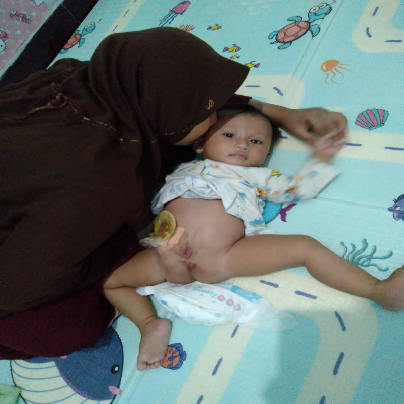 Bantu Operasi Lubang Anus dan Kelamin Anak Penjual Cimol