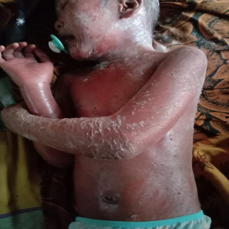 Urgent!!! Kulit di Sekujur Tubuh Dek Sopiah Melepuh
