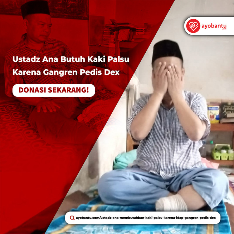 USTADZ ANA MEMBUTUHKAN KAKI PALSU KARENA IDAP (Gangren Pedis dex)