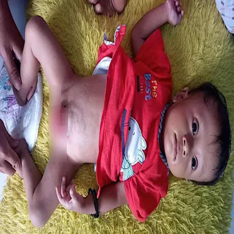 Bantu Dik Akbar (8 Bulan) Sembuh Melawan Penyakit Sejak Lahirnya.