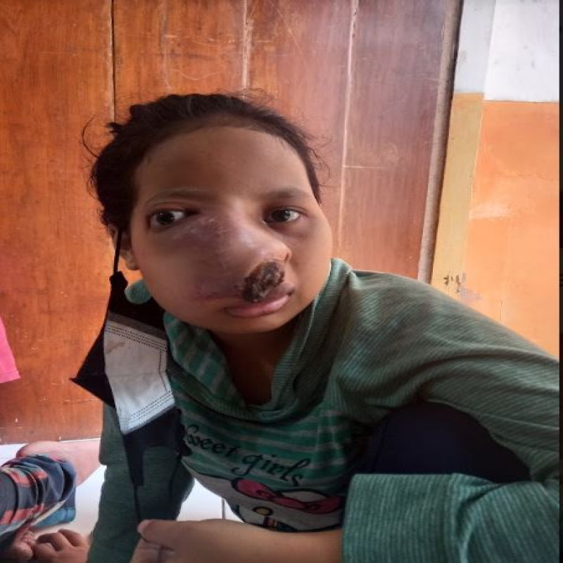 Kuatkan Perjuangan Nurcahyanik Melawan Tumor Ganas yang Mengancam Nyawanya