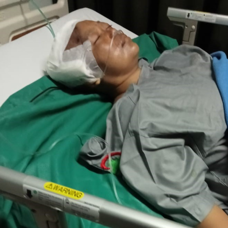 ISTRI KULI BANGUNAN HARUS JALANI BERKALI-KALI OPERASI BENJOLAN DI KEPALA