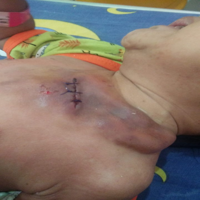 Kulitnya Melepuh Akibat Kemo, Bantu Nara Berjuang Lawan Leukemia