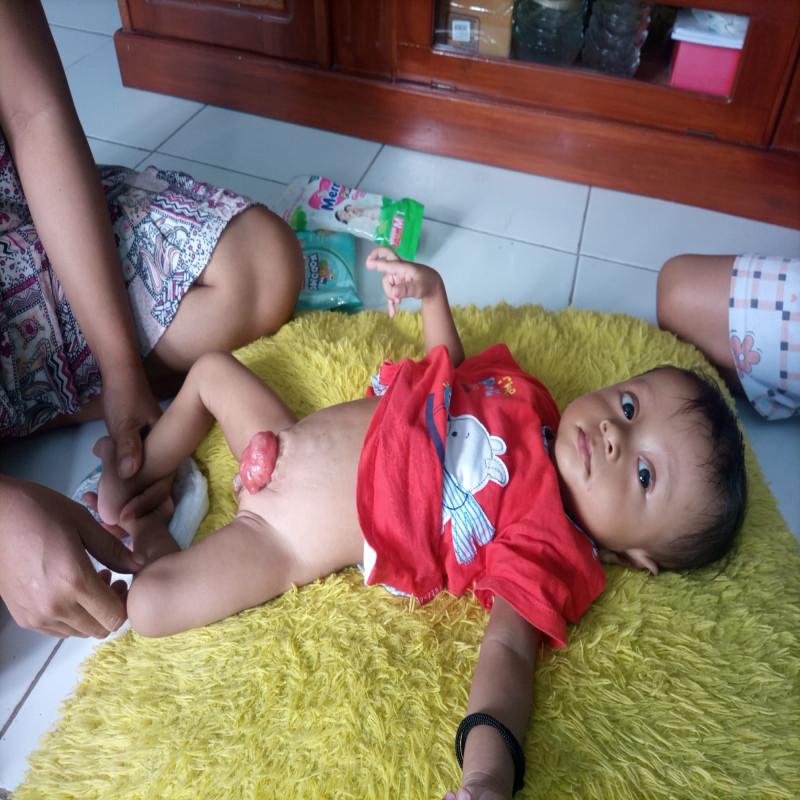 Bantu Dik Akbar (8 Bulan) Sembuh Melawan Penyakit Sejak Lahirnya.