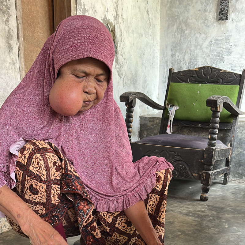 Leher Bengkak Tak Beraturan dan Bernanah, Mak Iroh Harus Segera Operasi!