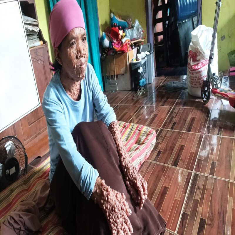 PILU! Sakit Langka, Kulit Bintik & Kaki Penuh Luka!