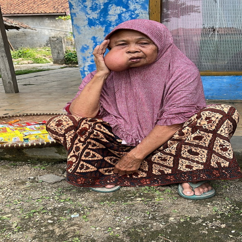 Leher Bengkak Tak Beraturan dan Bernanah, Mak Iroh Harus Segera Operasi!