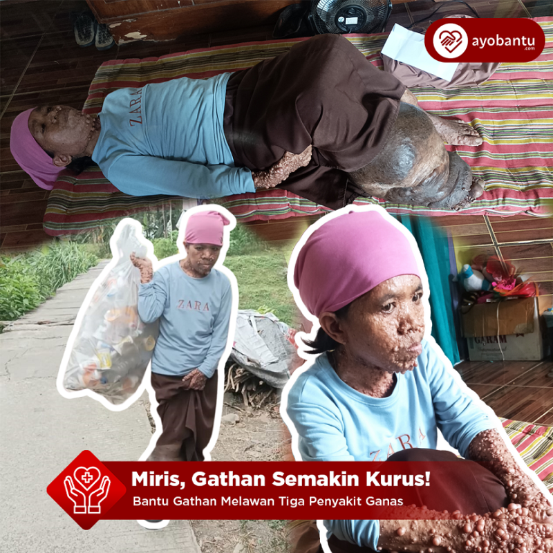 PILU! Sakit Langka, Kulit Bintik & Kaki Penuh Luka!