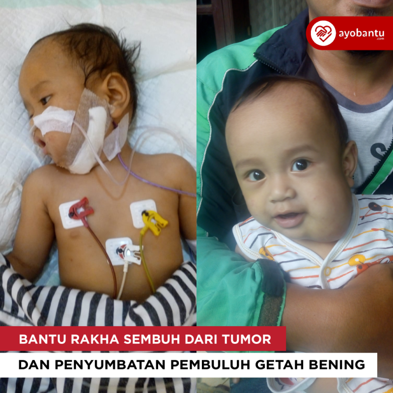 Bantu Rakha sembuh dari Tumor dan Penyumbatan pembuluh getah bening