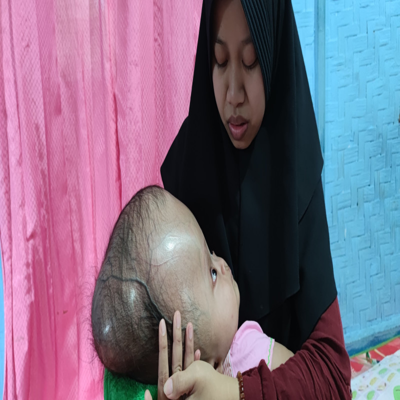 Bantu Bayi Mungil Berjuang Lawan Hidrosefalus