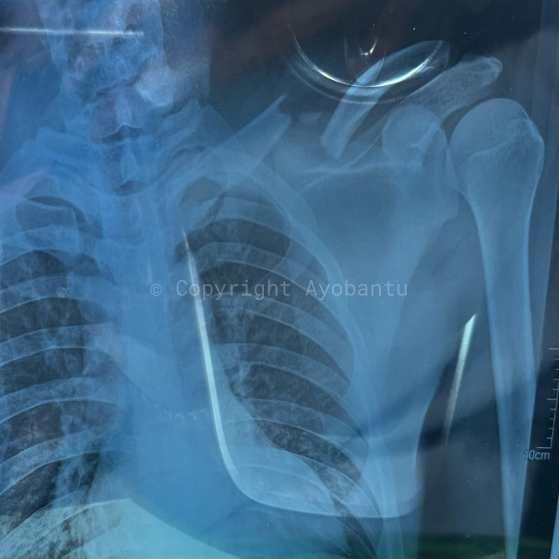 bantu Alung pulih dari cedera pleksus brakialis