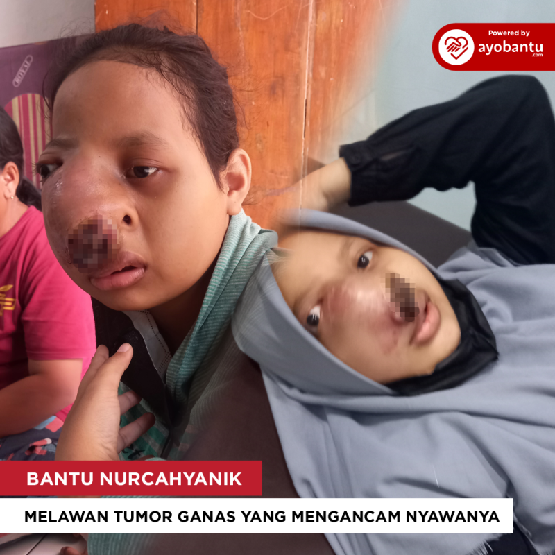 Kuatkan Perjuangan Nurcahyanik Melawan Tumor Ganas yang Mengancam Nyawanya