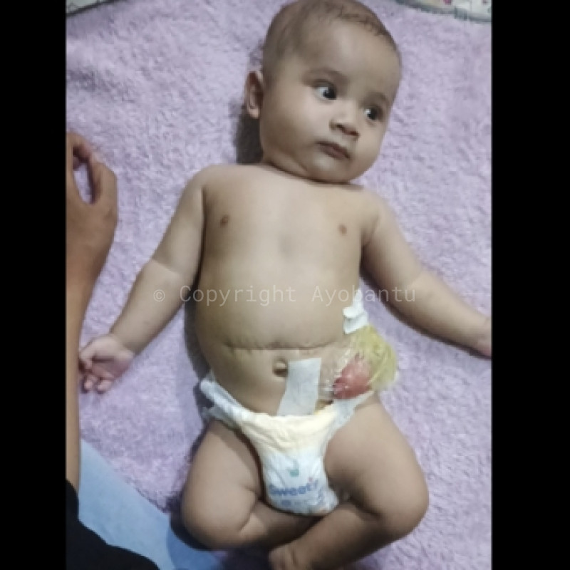 Bantu Bayi Ashfa Lahir Tanpa Anus, harus segera jalani 3 kali Operasi