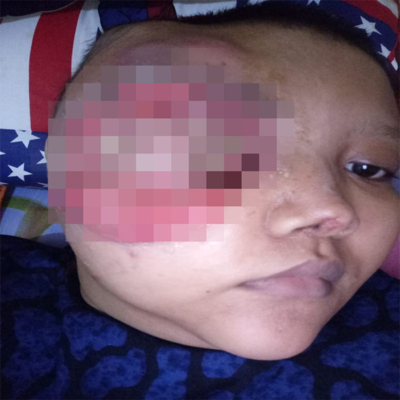 Berjuang Melawan Kanker Ganas yang Hendak Merenggut Hidupku