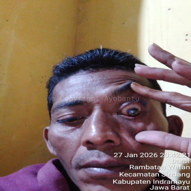 Bantu bapak Warjo melawan penyakit infeksi mata (glaucoma)