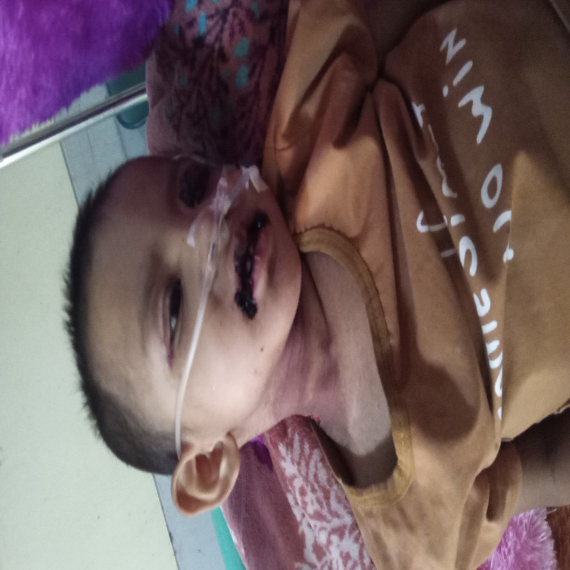 Mengindap Kanker Ganas Ewing Sarcoma (Kanker Tulang)