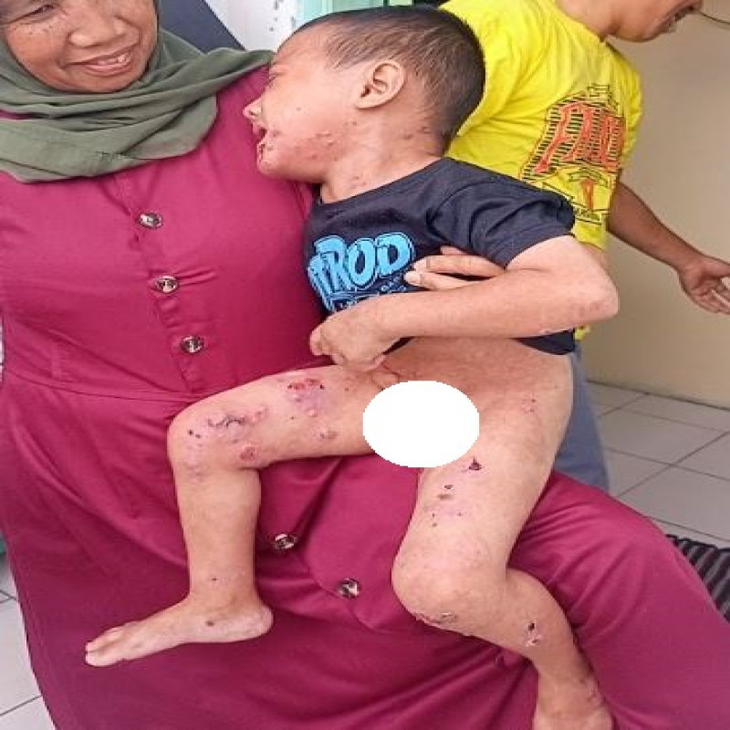 Kak, Penyakit Kulit Langka Serang Tubuh Mungilku, Bantu Dzikri Segera Berobat!