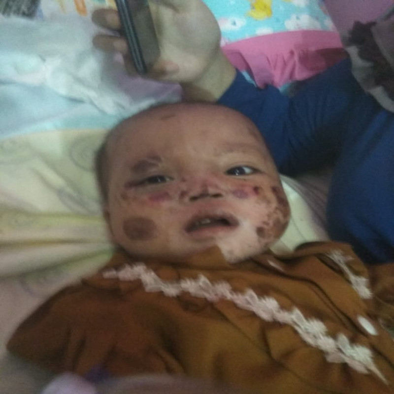 Kulitnya Melepuh Akibat Kemo, Bantu Nara Berjuang Lawan Leukemia