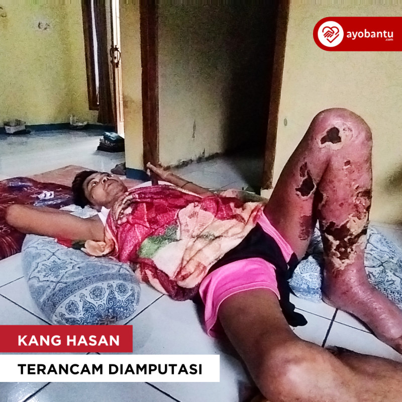 Kang Hasan Teracam Di Amputasi