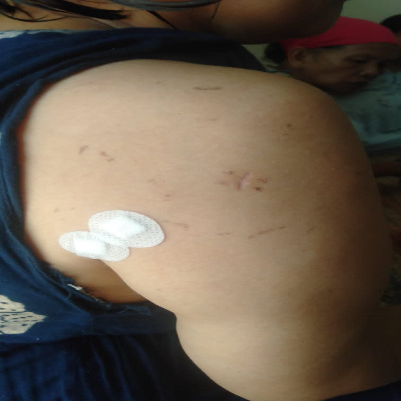Bantu ibu Maimunah melawan tumor wilm's pro