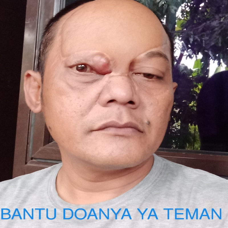 TUMOR GANAS SAYA TUMBUH KEMBALI