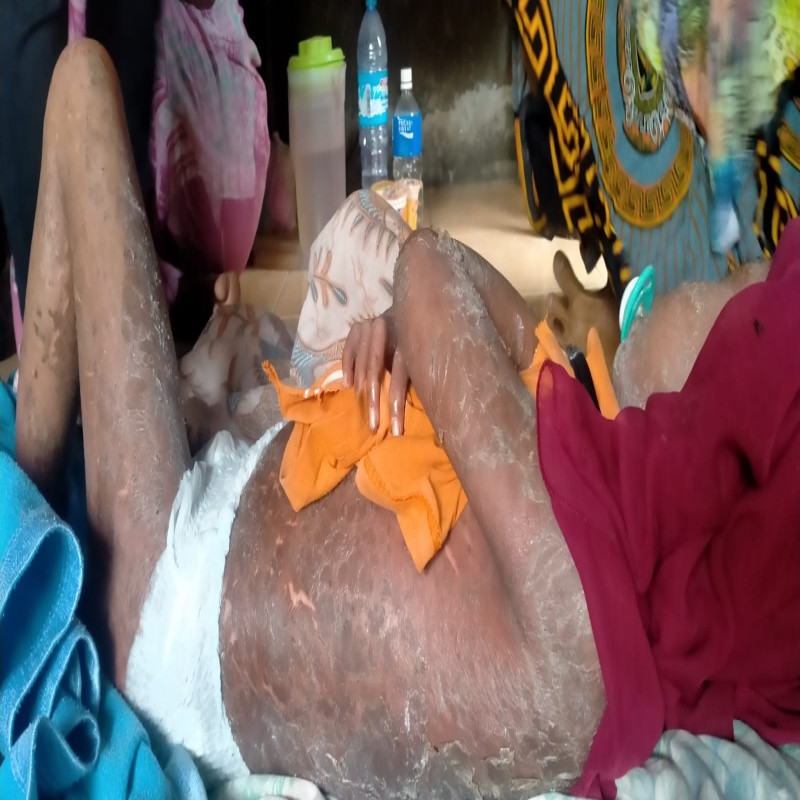 Urgent!!! Kulit di Sekujur Tubuh Dek Sopiah Melepuh