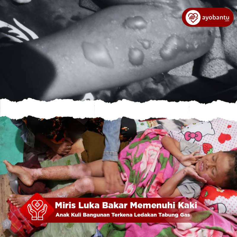 Urgent, Anak Kuli Bangunan Terkena Ledakan Tabung Gas