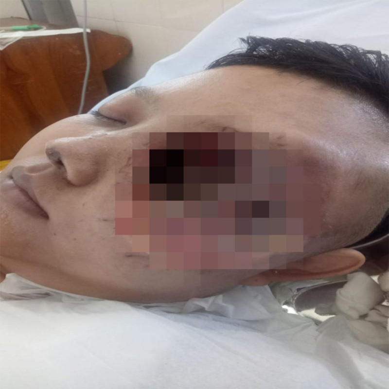 Berjuang Melawan Kanker Ganas yang Hendak Merenggut Hidupku