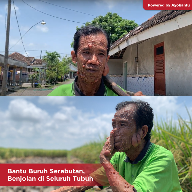 Bantu Buruh Serabutan, Benjolan di Seluruh Tubuh