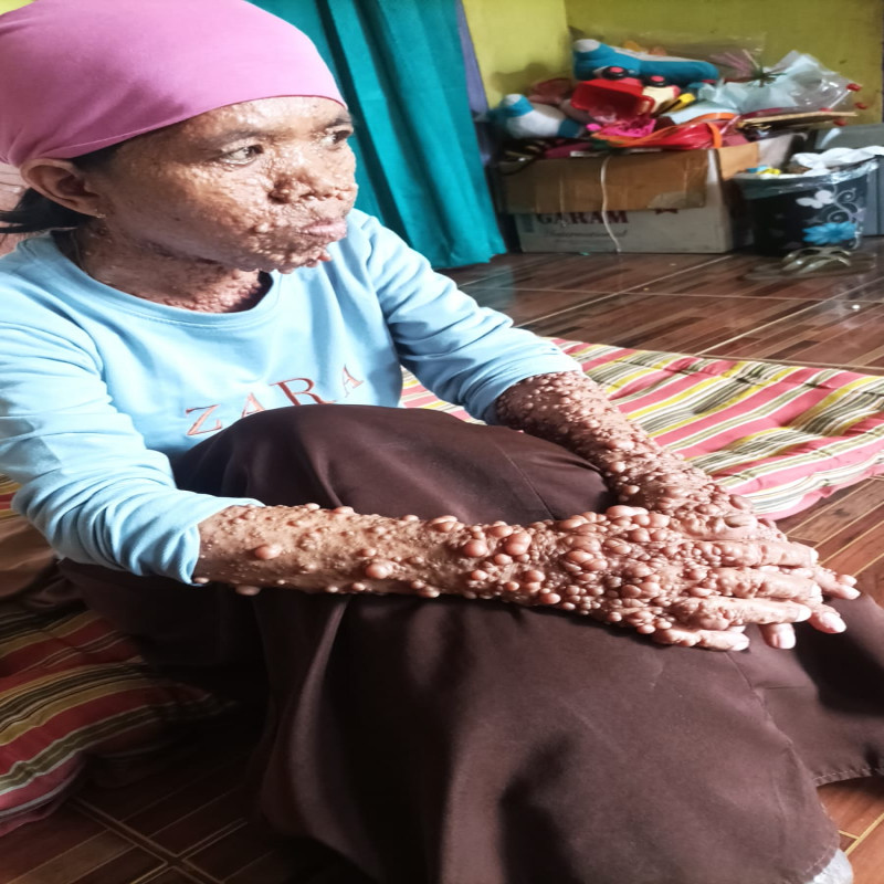 PILU! Sakit Langka, Kulit Bintik & Kaki Penuh Luka!