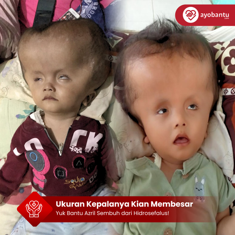 Ukuran Kepalanya Kian Membesar, Yuk Bantu Azril Sembuh dari Hidrosefalus!