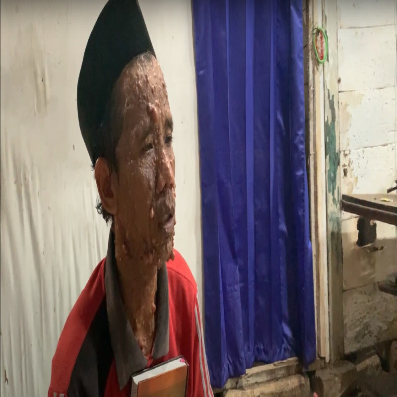 Bantu Buruh Serabutan, Benjolan di Seluruh Tubuh