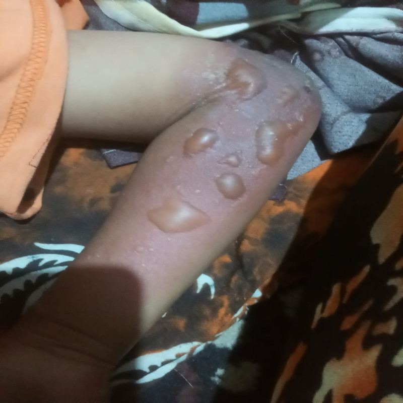 Urgent, Anak Kuli Bangunan Terkena Ledakan Tabung Gas