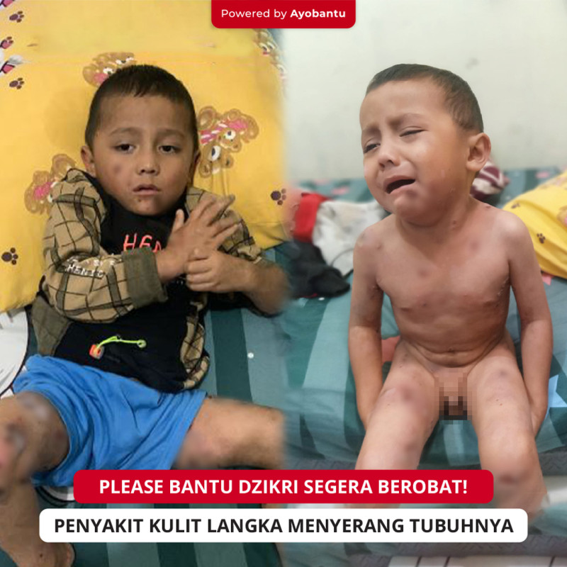 Kak, Penyakit Kulit Langka Serang Tubuh Mungilku, Bantu Dzikri Segera Berobat!