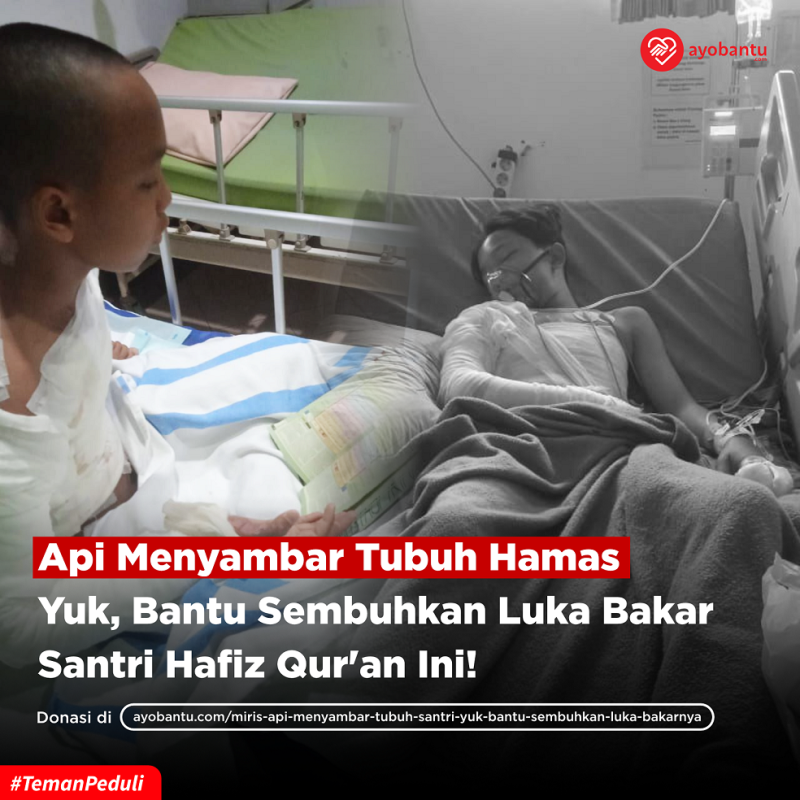 Miris!! Api Menyambar Tubuh Santri. Yuk Bantu Sembuhkan Luka Bakarnya